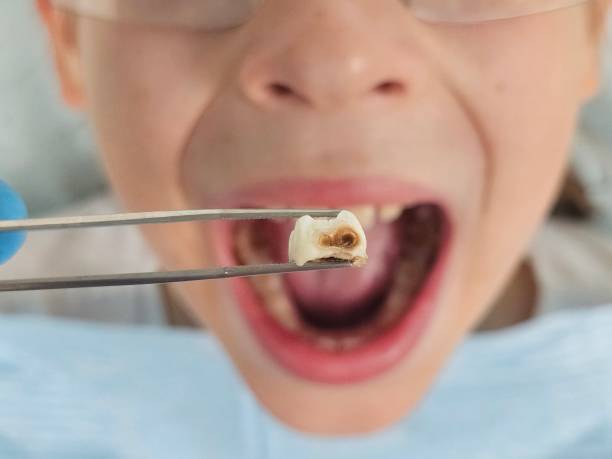 Best Dentist for Tooth Abscess  in Lake Dallas, TX